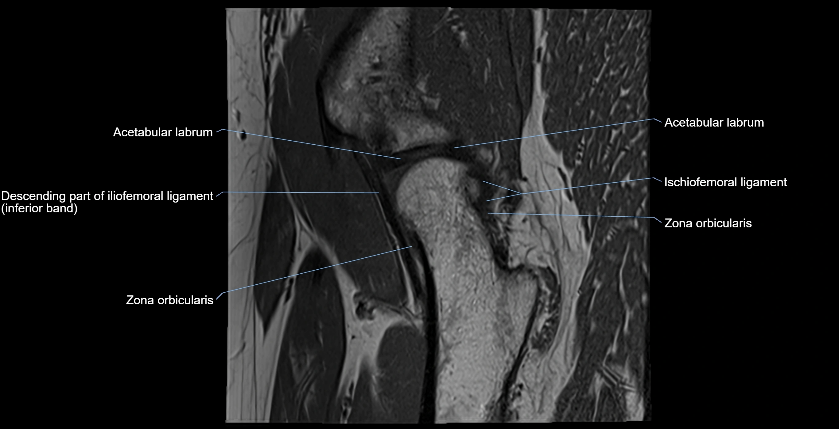 MRI Hip ligaments sagittal cross sectional anatomy 3T  radiology  image-img-00001-00015.webp